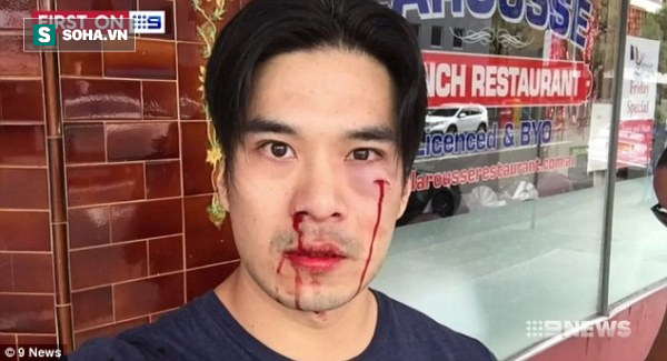 Tài tử gốc Việt điển trai nhất phim Truy sát bị đánh chảy máu mặt ở Australia  - Ảnh 2.