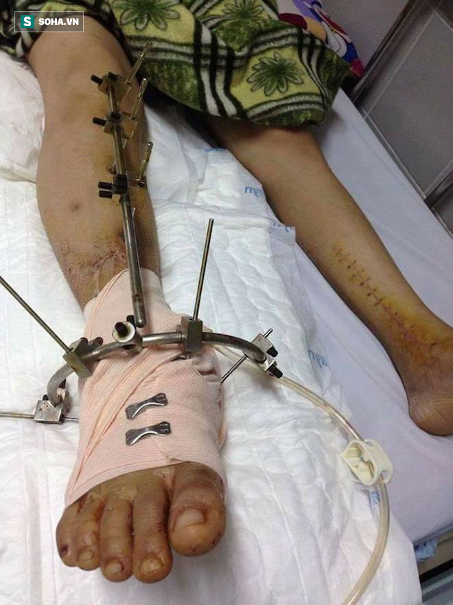 Con gái bị tai nạn có nguy cơ phải cắt cụt chân, cha nghèo cắm sổ đỏ vay tiền chữa trị - Ảnh 4.
