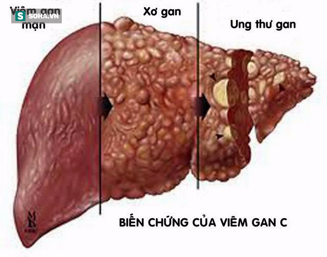 Giáo sư y khoa: 3 nguyên nhân gây xơ gan hàng đầu, biết sớm sẽ tránh được ung thư - Ảnh 1.