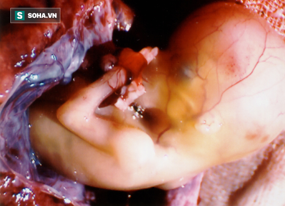 Phải cắt tử cung khi mới mang thai được 11 tuần: Cảnh báo biến chứng nguy hiểm khi mổ đẻ - Ảnh 1.
