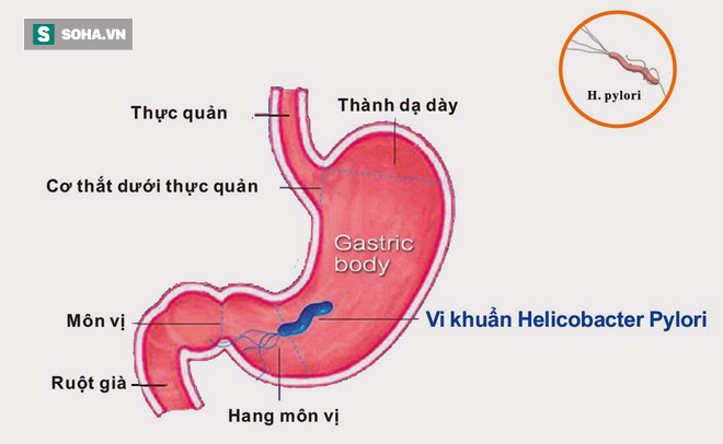 Cả gia đình đều dính vi khuẩn gây loét dạ dày: Đứng ngồi không yên vì sợ ung thư - Ảnh 2.