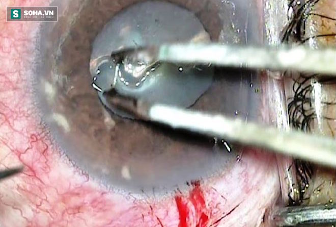 Kinh hãi: Video lấy con giun dài 14mm ra khỏi mắt người - Ảnh 3.