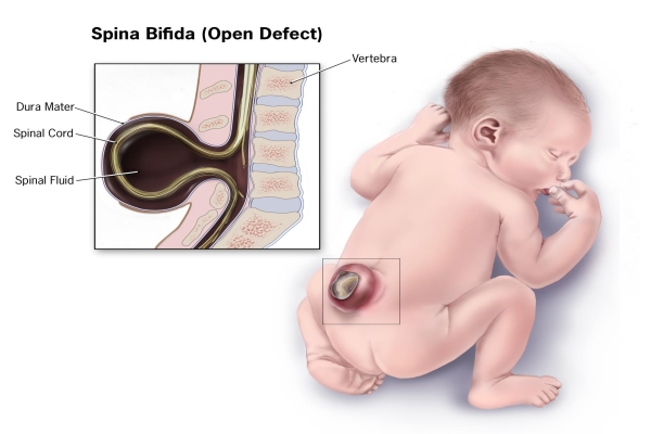 9 tuổi đã suy thận vì mắc bệnh Spina bifida không được phát hiện - Ảnh 1.