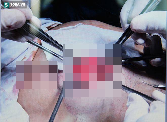 Tiêm silicone dạo, một phụ nữ bị hỏng cả ngực và mặt - Ảnh 1.