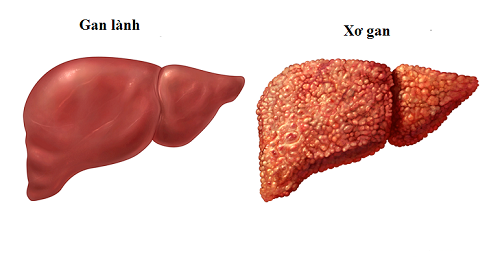 Biến gan thành xỉ than vì sát thủ 2.000 đồng mỗi ngày - Ảnh 1.