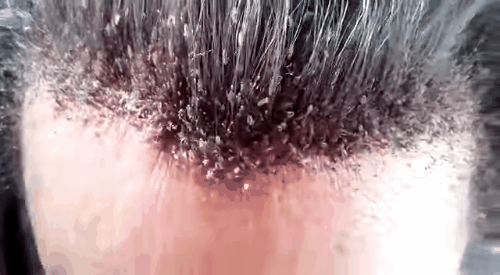 Nguy cơ đại dịch chấy tóc sắp bùng nổ khi 98% chấy rận đã kháng thuốc - Ảnh 1.
