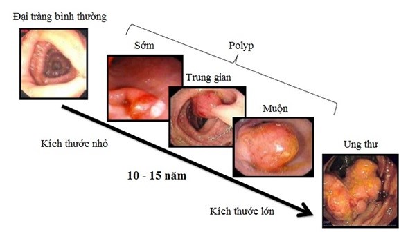 Chuyên gia chỉ đích danh thủ phạm gây ung thư trực tràng - Ảnh 2.