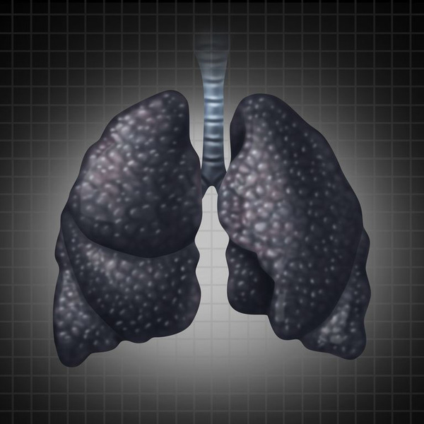 Đây là nguyên nhân và triệu chứng của bệnh ung thư phổi ở những người không hút thuốc - Ảnh 1.