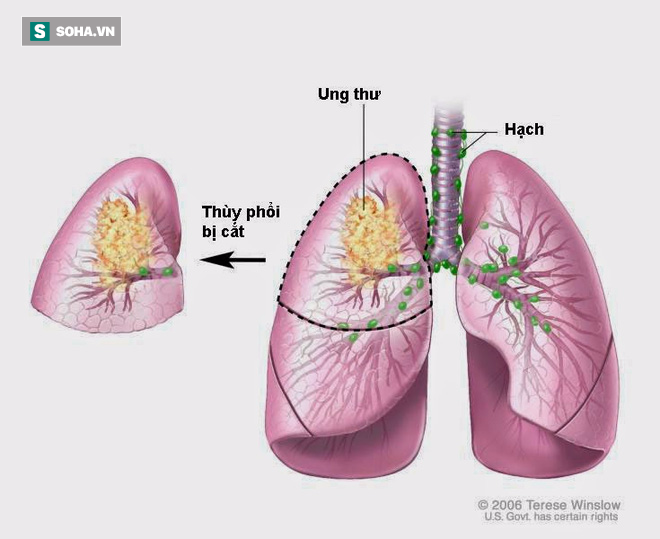 Căn bệnh ung thư phổi cực kỳ nguy hiểm - Ảnh 1.