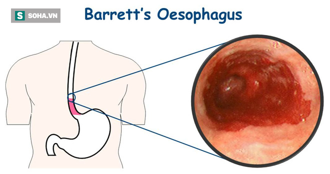 Bác sĩ khuyên bạn tránh 3 tác nhân gây bệnh ung thư thực quản - Ảnh 1.