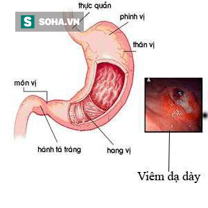 Uống bia cùng thịt nướng: Sướng miệng, khổ dạ dày - Ảnh 1.