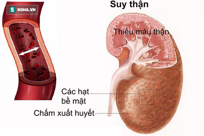 Dấu hiệu bất thường khi đi tiểu bạn cần chữa ngay kẻo suy thận - Ảnh 1.