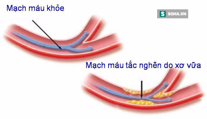 Bệnh tim mạch: Căn bệnh giết người nhiều hơn cả bệnh ung thư - Ảnh 1.