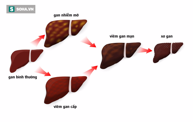 Chuyên gia chỉ rõ 3 thủ phạm gây ung thư gan cho đàn ông Việt - Ảnh 1.