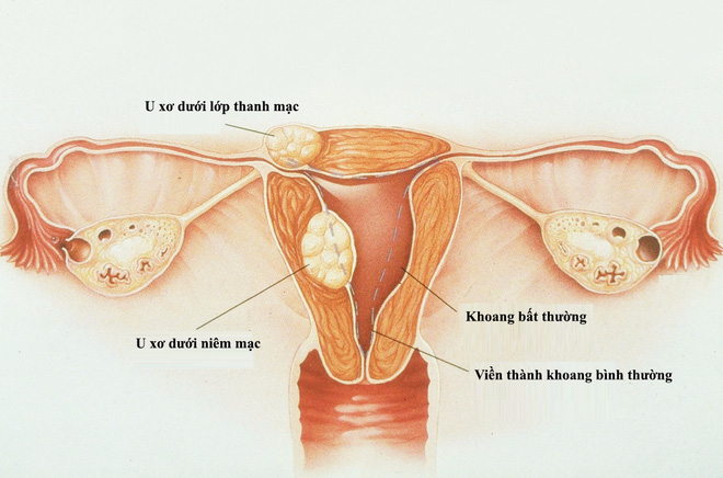 Ăn quá nhiều thịt, cô gái 19 tuổi đã có 36 khối u trong tử cung - Ảnh 4.