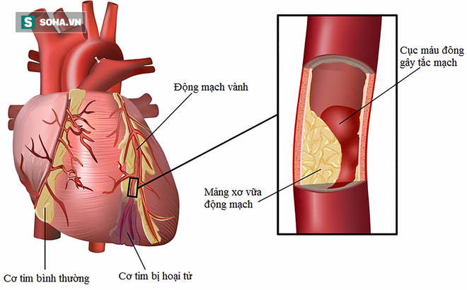 Bệnh gây chết người nhiều hơn cả ung thư nhưng ít người cảnh giác - Ảnh 2.