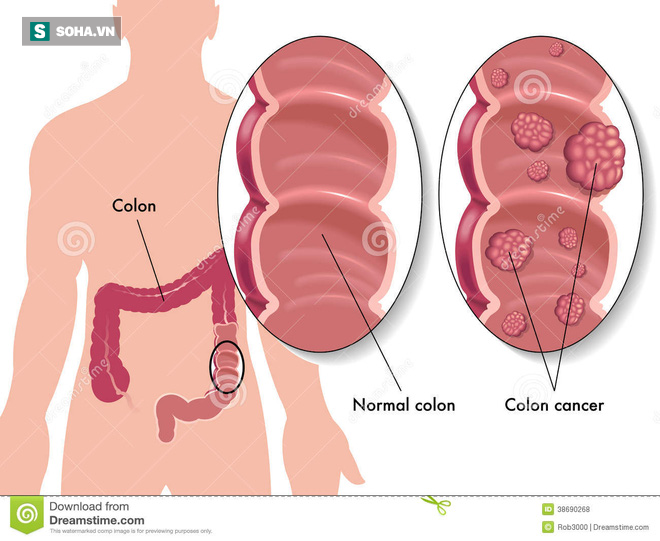 7 dấu hiệu sớm của bệnh ung thư trực tràng - Ảnh 1.