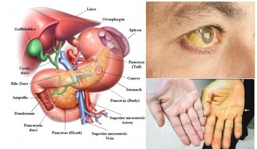 8 dấu hiệu sớm cảnh báo bạn bị bệnh ung thư tuyến tụy - Ảnh 2.