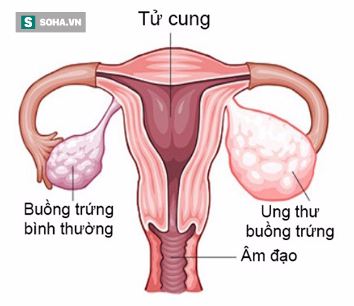 Bác sĩ cảnh báo: Phụ nữ từ 14 tuổi trở lên không được chủ quan với bệnh ung thư này - Ảnh 2.