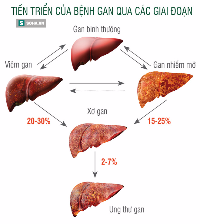 3 mẹ con mắc ung thư gan: Giật mình con đường ngắn tới ung thư nhiều người 1 nhà cùng mắc - Ảnh 1.