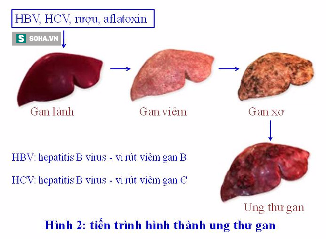 3 mẹ con mắc ung thư gan: Giật mình con đường ngắn tới ung thư nhiều người 1 nhà cùng mắc - Ảnh 2.