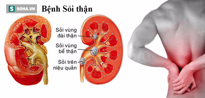 6 dấu hiệu cảnh báo sớm rối loạn chức năng thận ai cũng nên thuộc lòng - Ảnh 2.