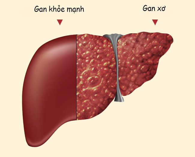 Hàng loạt virus gây bệnh viêm gan, hầu hết chúng ta không biết - Ảnh 1.