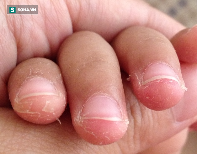 Bé 7 tuổi suýt bị cắt bỏ ngón tay vì thói quen cắn: Bố mẹ nên cai nghiện cho con  - Ảnh 2.