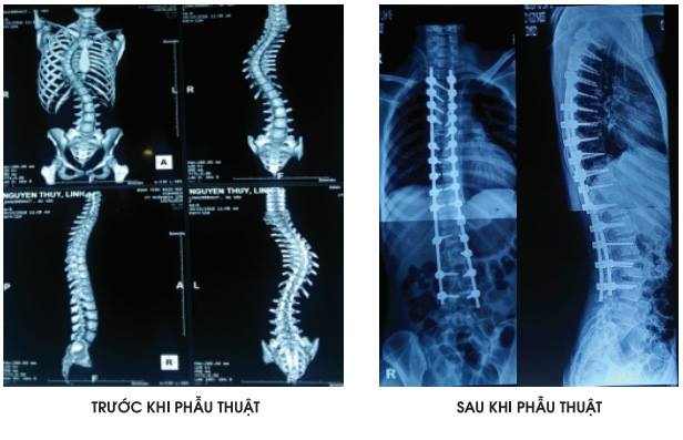 Bệnh viện Bạch Mai áp dụng công nghệ chẩn đoán, điều trị cột sống hiện đại nhất thế giới - Ảnh 4.