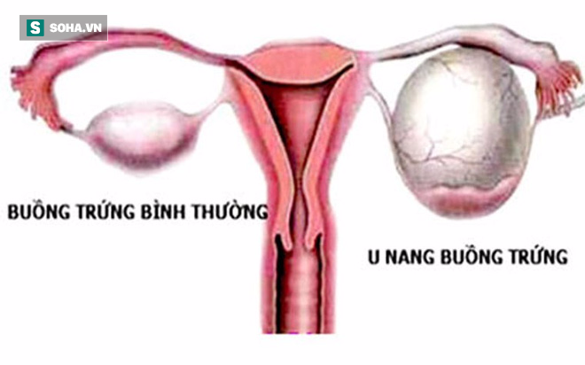 Bé gái 11 tuổi bụng to như cái trống, bố mẹ chủ quan nghĩ con béo bụng nhưng hóa ra.... - Ảnh 2.