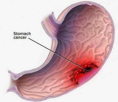 Ung thư dạ dày: Án tử cho những người chủ quan - Ảnh 1.