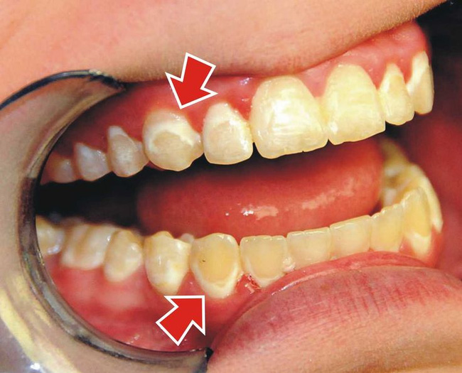 Răng bạn có những đốm trắng này không - hãy cẩn thận nếu thấy chúng - Ảnh 2.