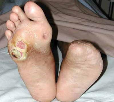 Căn bệnh khiến 150 nghìn người bị cắt cụt chân mỗi năm: Ai cũng cần biết để phòng tránh - Ảnh 2.