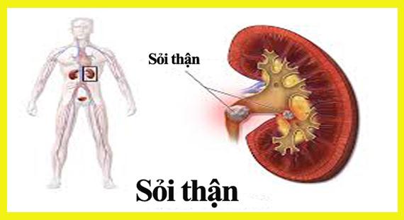 Sỏi thận: Căn bệnh nguy hiểm không chừa một ai - Ảnh 1.