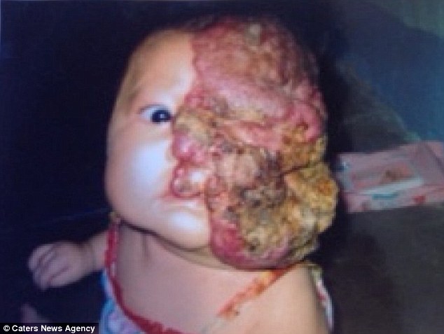 Cô bé người Việt mang khối u che hết nửa gương mặt bất ngờ được một người phụ nữ Mỹ cứu giúp - Ảnh 1.