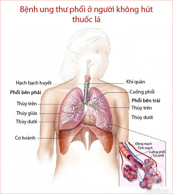 Đây là nguyên nhân và triệu chứng của bệnh ung thư phổi ở những người không hút thuốc - Ảnh 2.