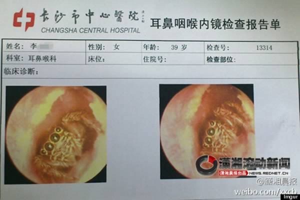 Những dị vật kinh hoàng mắc kẹt trong lỗ tai người - Ảnh 3.