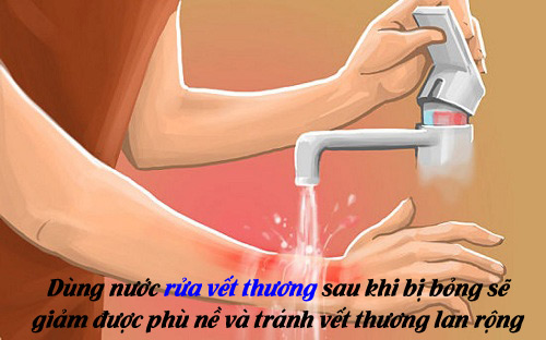 Chuyên gia hướng dẫn cách sơ cứu đơn giản, hiệu quả khi trẻ bị bỏng - Ảnh 3.