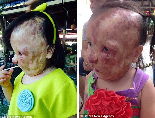 Cô bé người Việt mang khối u che hết nửa gương mặt bất ngờ được một người phụ nữ Mỹ cứu giúp - Ảnh 3.
