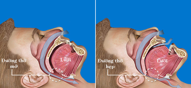 Ngủ ngáy và căn bệnh ẩn sau đó khiến bạn lo sợ - Ảnh 2.