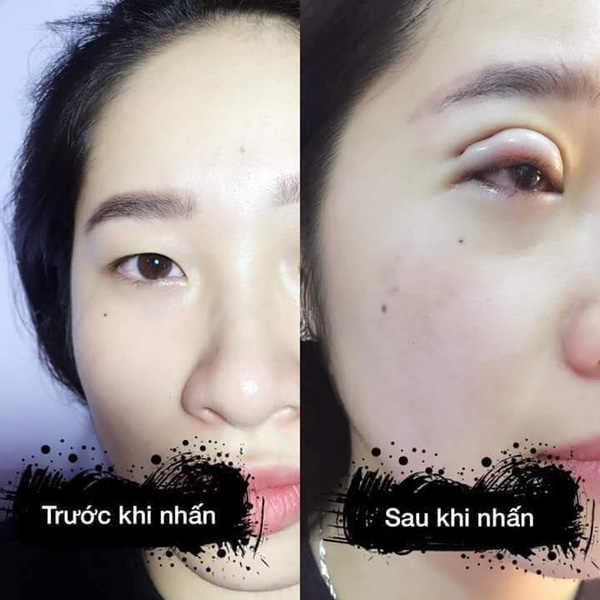 Chị em giật mình xôn xao vì cô gái trẻ đi nhấn mí bị sưng trông như... đắp bì lợn lên mắt - Ảnh 3.