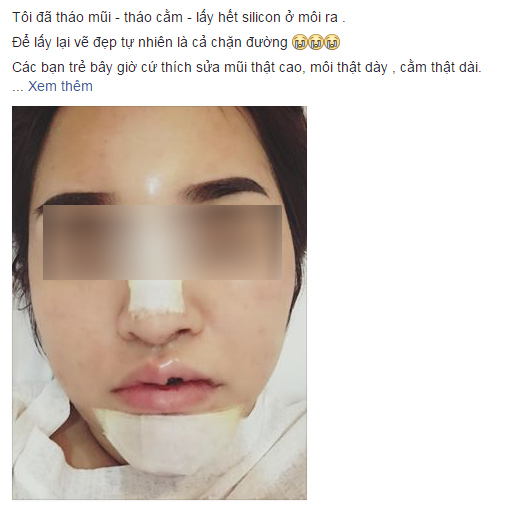 Lời khuyên gửi chị em của cô gái Hà Nội vừa thẩm mỹ xong lại chịu đau để gỡ hết độn cằm, tháo mũi, nạo silicon ở môi - Ảnh 4.