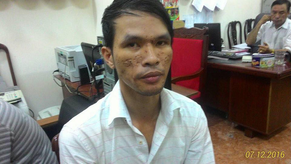 Hình ảnh mới nhất của bé trai người Campuchia bị chích điện, bạo hành dã man - Ảnh 3.