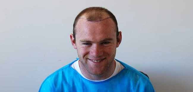 Chi cả tỷ đồng cứu chữa, tóc của Rooney vẫn lơ thơ như ông già - Ảnh 4.