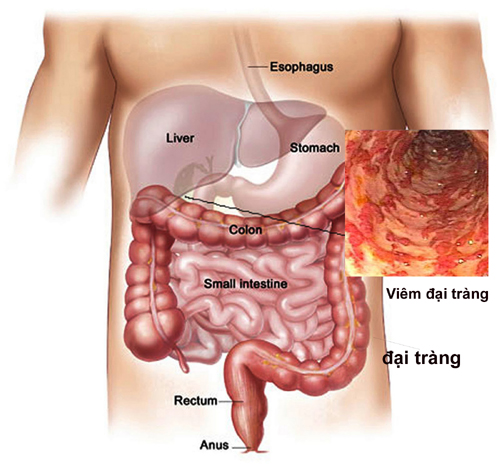 5 dấu hiệu giúp tự nhận biết sớm ung thư đại trực tràng  - Ảnh 4.