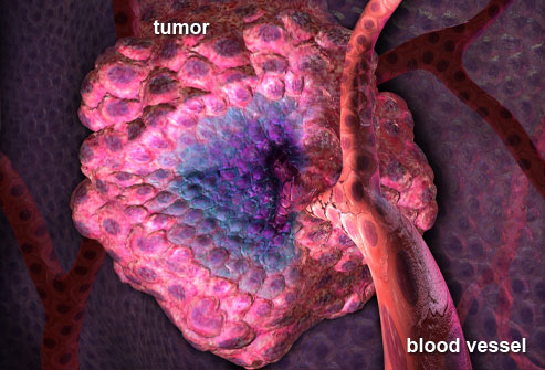 Dấu hiệu sớm phát hiện ung thư buồng trứng - Ảnh 4.