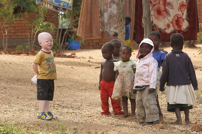 Thảm cảnh những đứa trẻ bạch tạng châu Phi bị giết hại để lấy bộ phận cơ thể làm tà thuật - Ảnh 6.