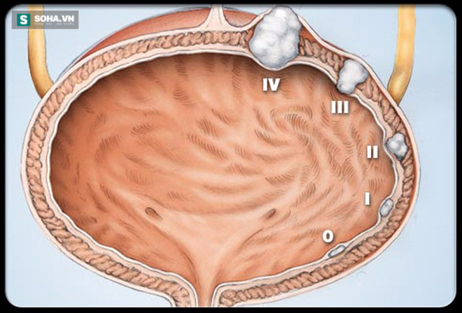 Đi tiểu ra máu – dấu hiệu ung thư sớm bạn không nên bỏ qua - Ảnh 1.