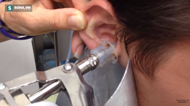 Video: Giật mình cảnh bác sĩ lấy ráy tai siêu khủng - Ảnh 2.