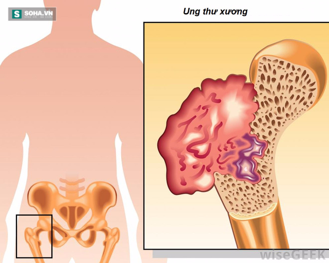 Ung thư xương: Căn bệnh nguy hiểm cần phải điều trị sớm - Ảnh 2.